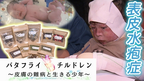 ザ・ドキュメンタリー バタフライチルドレン～皮膚の難病と生きる少年～