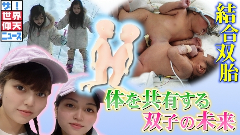ザ!世界仰天ニュース まさに奇跡の生活を送る双子